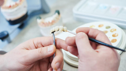 Per garantire la piena funzionalità della bocca si possono applicare protesi con elementi dentari artificiali.