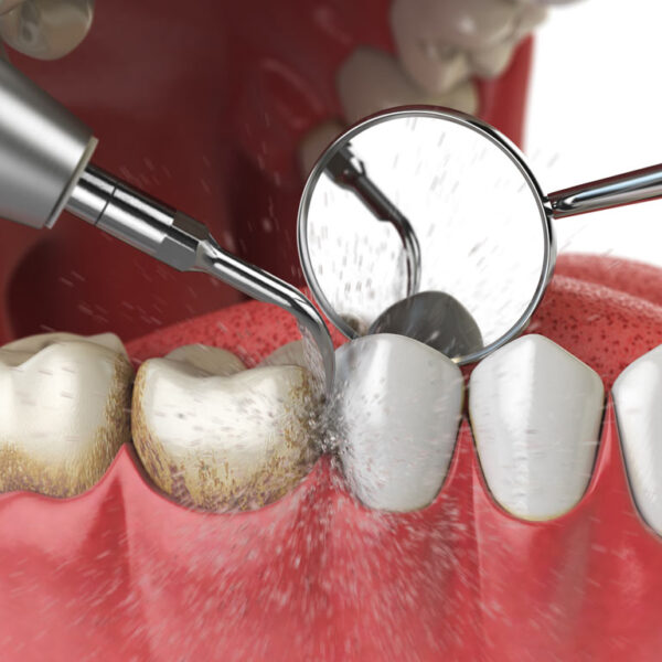 Come avviene pulizia dentale Come avviene pulizia dentale