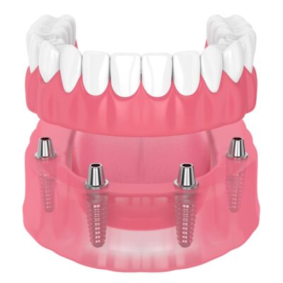 Protesi ancorate su impianti dentali Protesi ancorate su impianti dentali