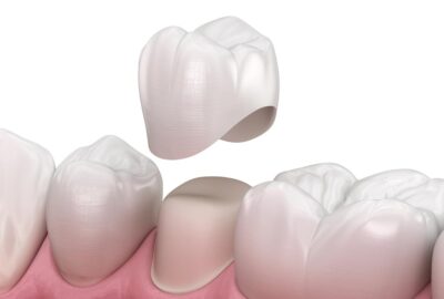 capsule dentali capsule dentali
