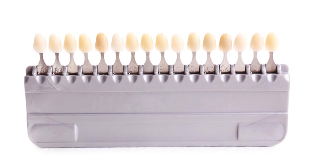 faccette in ceramica faccette in ceramica