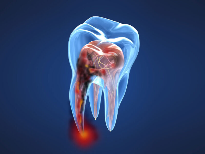 studio dentistico porro artusa esempio carie studio dentistico porro artusa esempio carie