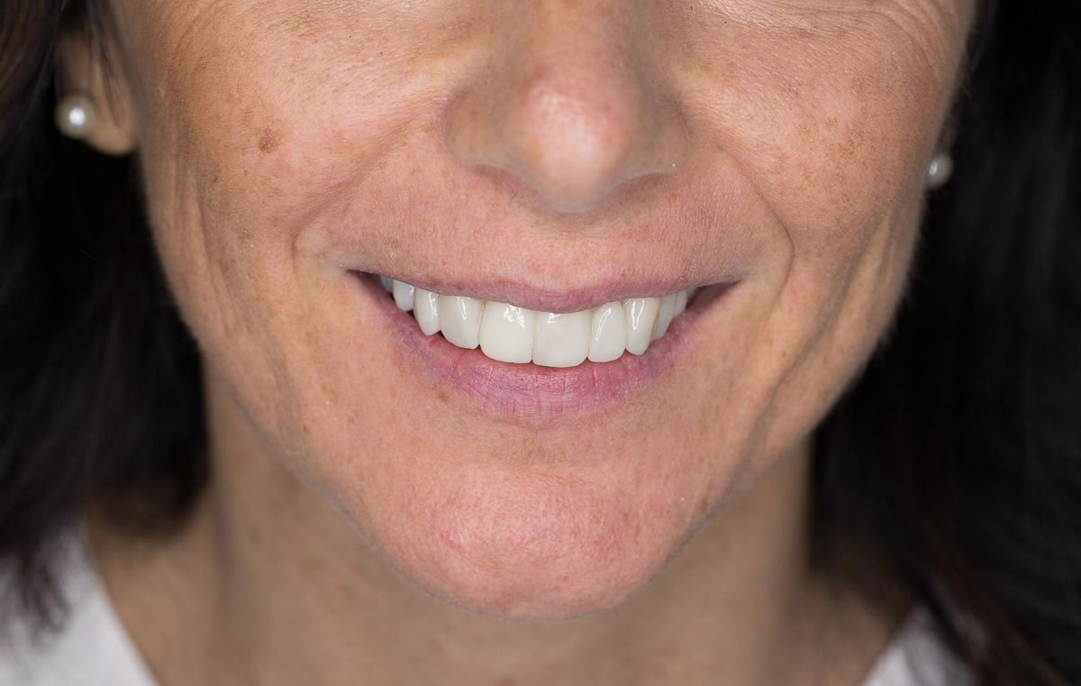 faccette dentali dopo