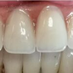 caso clinico 1 impianti fissi