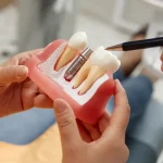 implantologia dentale segrate