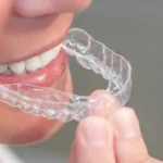 ortodonzia adulti apparecchio